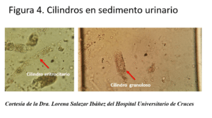 Primer consenso nacional de edema macular diabético First national ...