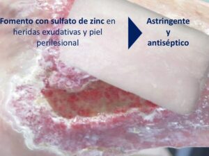 Fomentos astringentes y antisépticos en heridas y piel perilesional