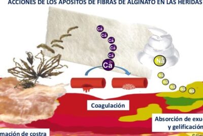 Por qué utilizamos tanto alginato en nuestra consulta de heridas ...